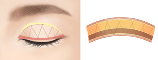Double-Eyelid-Surgery3