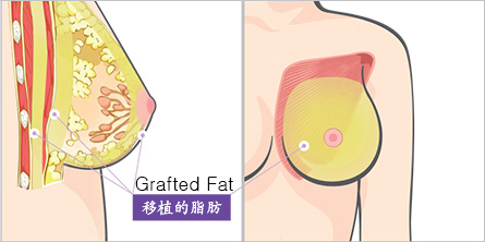 韩国自体脂肪丰胸手术示意图