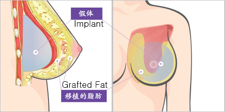 韩国假体脂肪复合式隆胸示意图