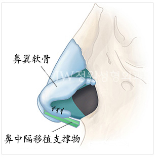 韩国箭头鼻长鼻矫正最好的整形医院JW整形医院
