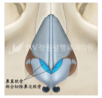 韩国箭头鼻长鼻矫正最好的整形医院JW整形医院