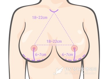 breast-revision-jw-plastic-surgery-clinic-1