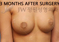breast-revision-surgery-jw-plastic-surgery-clinic-1br